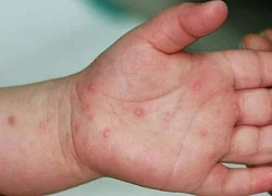 Bệnh tay chân miệng mắc chủ yếu ở trẻ nhỏ