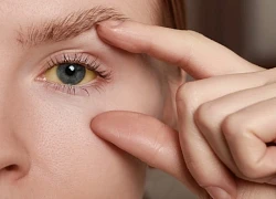 Dấu hiệu cảnh báo gan nhiễm mỡ 'hiện hình' ngay trên mặt nhiều người lại bỏ qua