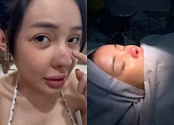 Ngân 98 bị biến chứng nhiễm trùng nặng sau 11 lần phẫu thuật thẩm mỹ