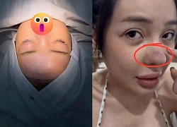 Ngân 98 lộ nốt sưng đỏ ở mũi, hủy gấp 2 show tại Campuchia, bác sĩ chẩn đoán sốc