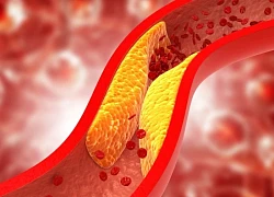 Nguyên nhân khiến người gầy vẫn bị bệnh mỡ máu