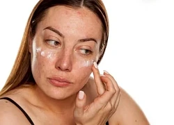 Những điều không nên bỏ qua khi điều trị nám da