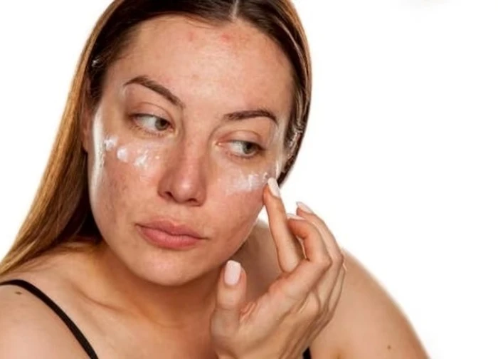 Những điều không nên bỏ qua khi điều trị nám da