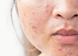 Thực phẩm dễ gây mụn trứng cá