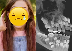 Hy hữu cô bé có đến 81 chiếc răng, vượt giới hạn bình thường, bác sĩ &#8220;bó tay&#8221;?
