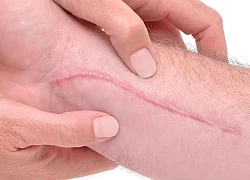 Kiêng gì để tránh bị sẹo lồi?