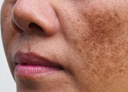 Nám và tàn nhang phân biệt thế nào?