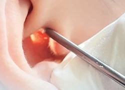 TPHCM: Cấp cứu người mẹ thủng màng nhĩ vì con trai chơi bóng trong nhà