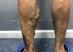 Căn bệnh diễn tiến âm thầm có dấu hiệu trẻ hóa, dân văn phòng có nguy cơ mắc