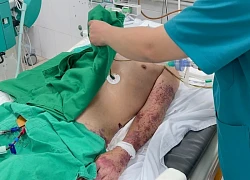 Đã có người tử vong vì nhiễm liên cầu lợn, Bộ Y tế khuyến cáo 6 cách phòng, chống bệnh