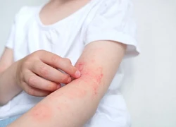 Giun bò lổm ngổm dưới da vì một thói quen ăn uống