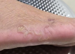 Làm vườn không mang bảo hộ, nữ bệnh nhân bị nhiễm giun móc chó mèo