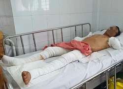 Người đàn ông bị điện phóng cụt 2 tay nghẹn ngào: "Mọi người đừng như tôi"