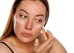 Vì sao nám da dễ tái phát sau khi đã điều trị thành công?