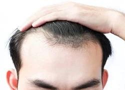 Dấu hiệu nhận biết sớm hói đầu và những lầm tưởng phổ biến