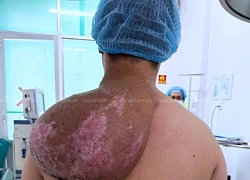 Chàng trai biến dạng cơ thể, 5 năm mang "tảng đá" trên vai vì căn bệnh hiếm