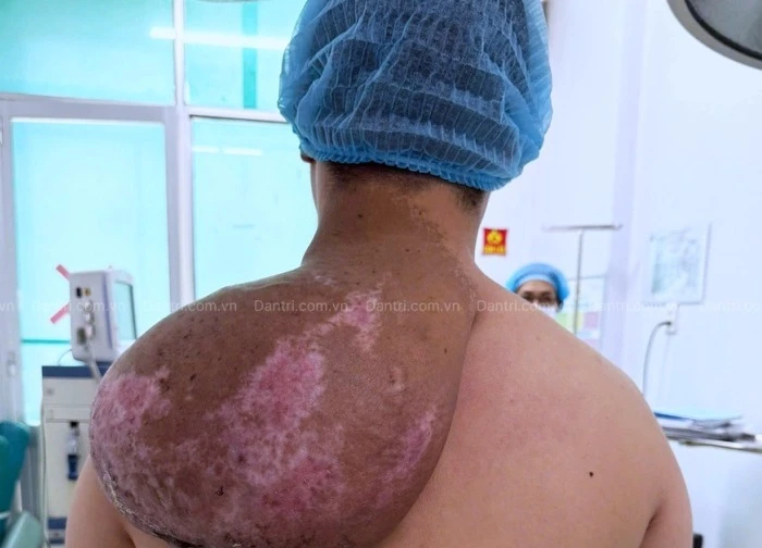 Chàng trai biến dạng cơ thể, 5 năm mang "tảng đá" trên vai vì căn bệnh hiếm