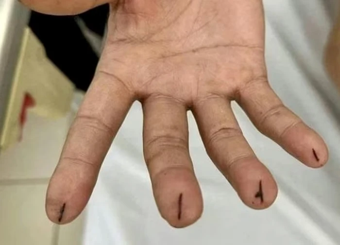 Chích máu chữa đột quỵ: Bác sĩ nói gì?