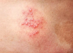 Liệt mặt do zona: Hiểm họa có thể phòng ngừa