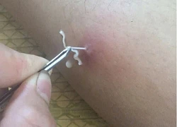 Những món ăn quen thuộc trên mâm cơm người Việt là ổ ký sinh trùng