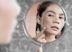 Tại sao da ta có nám?