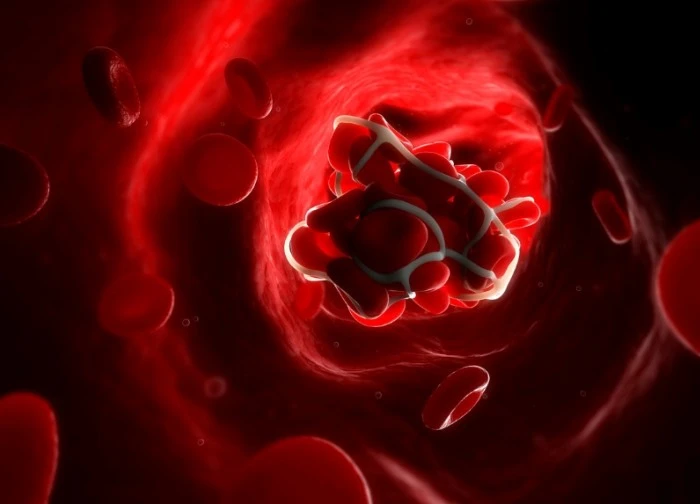 Việt Nam thuộc nhóm nước có tỷ lệ đột quỵ cao nhất Đông Nam Á