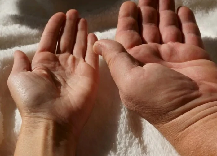 Bệnh to đầu chi: Phát hiện sớm tránh biến chứng nguy hiểm