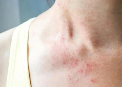 Kem dưỡng da không chứa steroid trị bệnh chàm tay