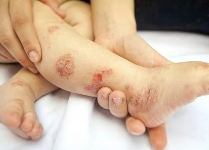 Trẻ bị viêm da cơ địa: nên tránh ăn gì?