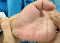 Bé trai nhiễm sán máng sau trò chơi tưởng chừng vô hại