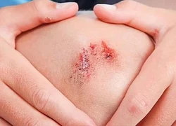 Căn bệnh nguy hiểm chỉ từ vết thương nhỏ