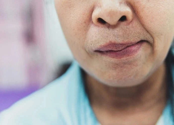 Liệt mặt do zona có biểu hiện như thế nào?