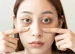Quầng thâm dưới mắt Cảnh báo thiếu hụt vitamin và khoáng chất bạn không nên bỏ qua