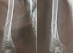 Chơi vật tay, chàng trai Hà Nội gãy xương