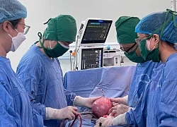 Người phụ nữ mang khối u xơ tử cung nặng 3kg, tương đương một thai nhi