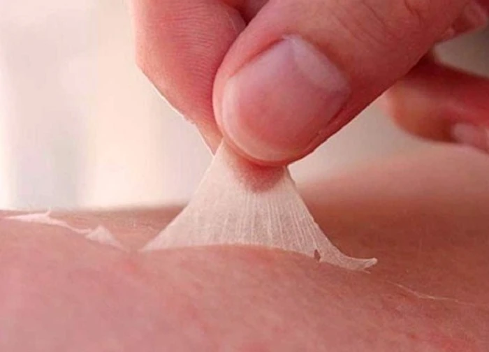 Bỏng da, rôm sảy do nắng nóng, bác sĩ khuyến cáo cách phòng tránh
