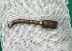 Đang khoan đá thanh niên bị mũi khoan 'lưỡi câu' xuyên hốc mũi