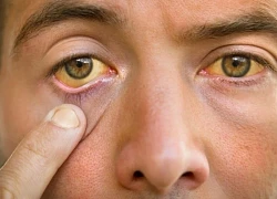 9 triệu chứng của gan nhiễm mỡ dễ thấy nhất trên da