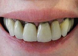 Bác yêu cầu của 1 Việt kiều Mỹ đòi bồi thường do làm răng sứ bị hư
