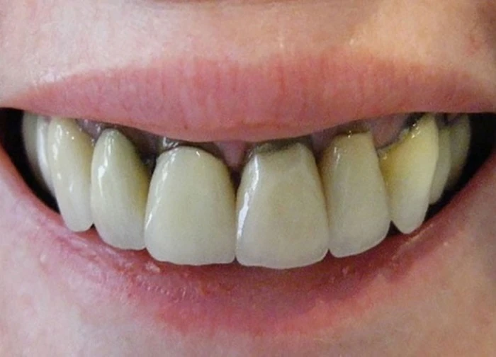 Bác yêu cầu của 1 Việt kiều Mỹ đòi bồi thường do làm răng sứ bị hư