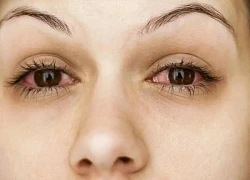 Đừng bỏ qua 5 dấu hiệu ở mắt có thể là lời kêu cứu từ thận