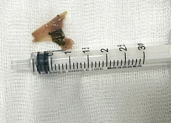 Xương vịt dài 2cm trong cổ họng trẻ 12 tuổi
