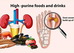 3 thói quen xấu khiến axit uric tăng cao