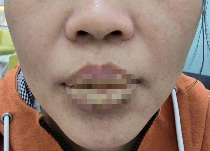 Bi hài hậu vận thẩm mỹ: Xăm môi làm đẹp, người phụ nữ nhận trái đắng với biến chứng kinh hoàng