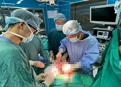 Người phụ nữ bất ngờ phát hiện có khối u thận khổng lồ