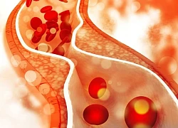 Rối loạn lipid máu ở bệnh nhân tiểu đường cần lưu ý gì?