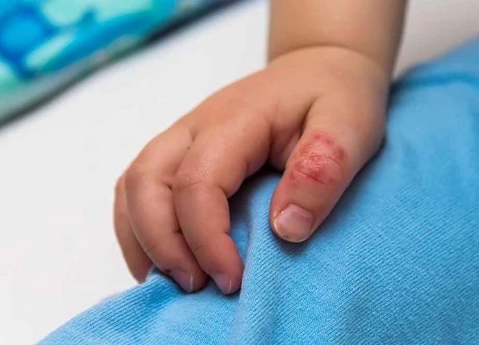 Dấu hiệu cảnh báo bệnh ghẻ ở trẻ