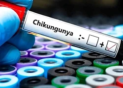 Không nên tự ý điều trị khi có dấu hiệu mắc Chikungunya