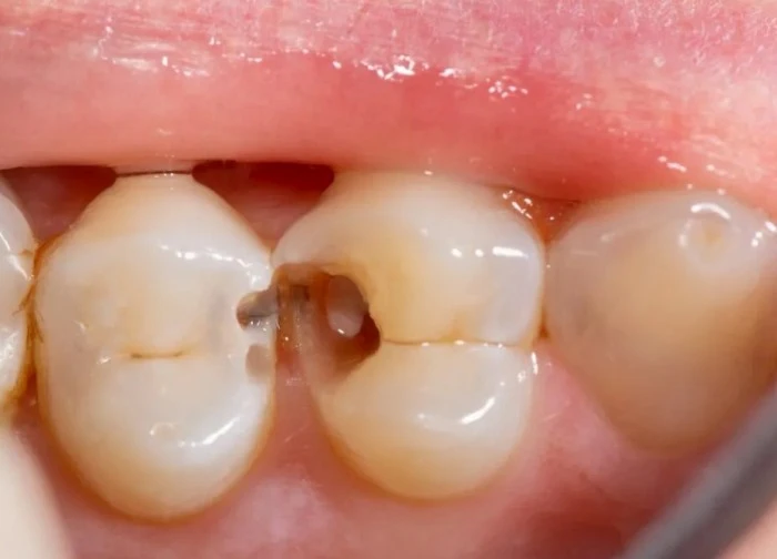 Nhận biết và đề phòng sâu răng ở trẻ