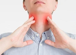 Đau họng kéo dài do viêm amidan hốc mủ